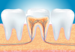 Animation of damaged root canal